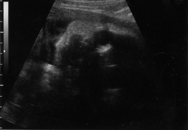 Calvin's
ultrasound at 32 weeks